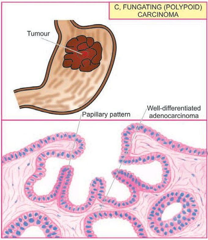 Gastric carcinoma