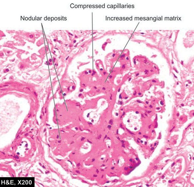 Diabetic nephropathy