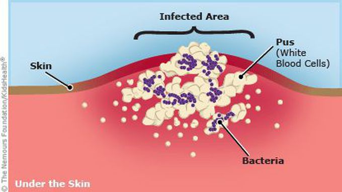 Abscess