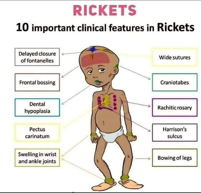 Rickets symptoms