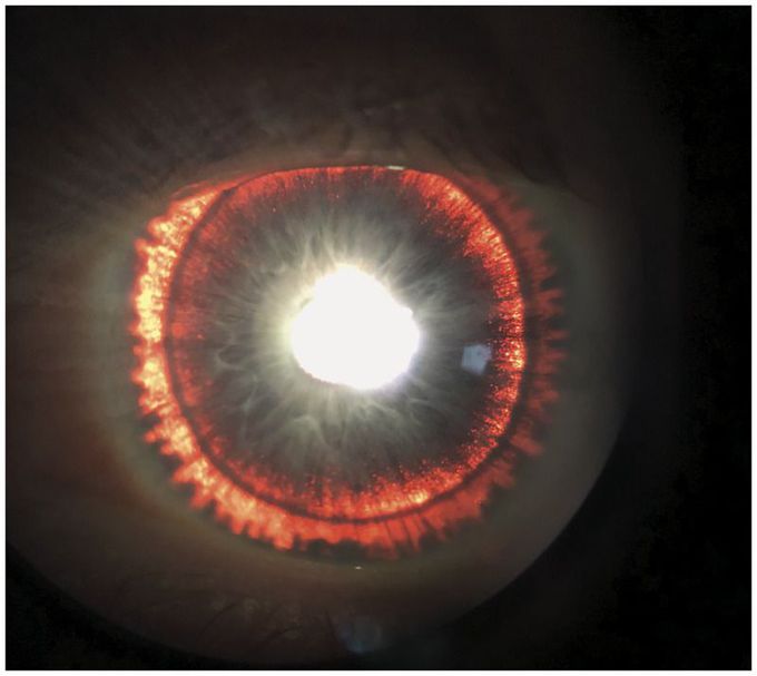 Iris Transillumination Defects in Pigment Dispersion Syndrome