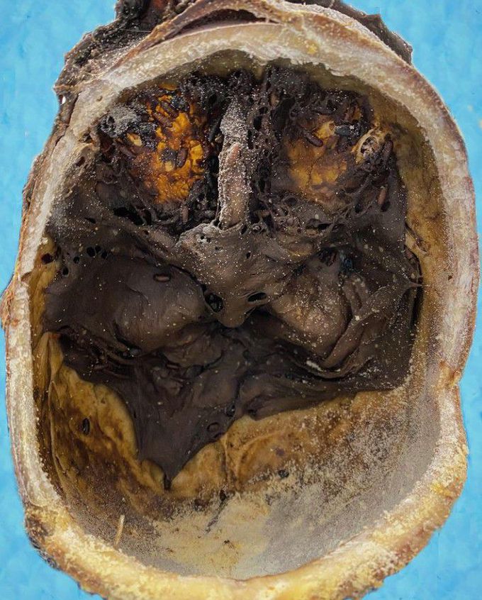 Normal decomposition of skull