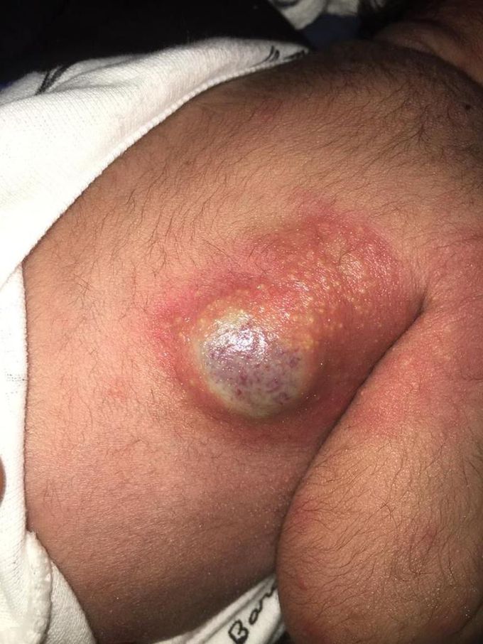 A 4 days old infant presented with rashes on the face and a swelling on his right posterolateral side of his back