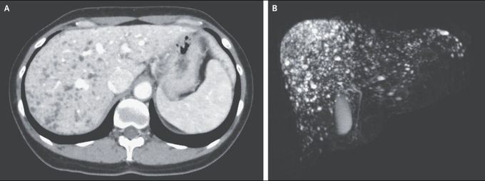 Starry Sky” Appearance from Multiple Biliary Hamartomas