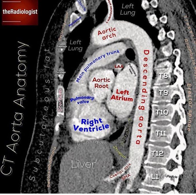 CT aorta