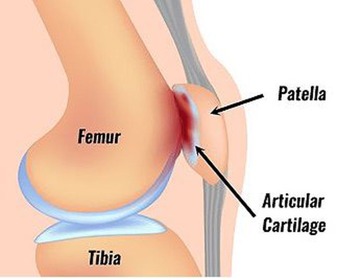 Patellofemoral knee syndrome (Runner's knee)