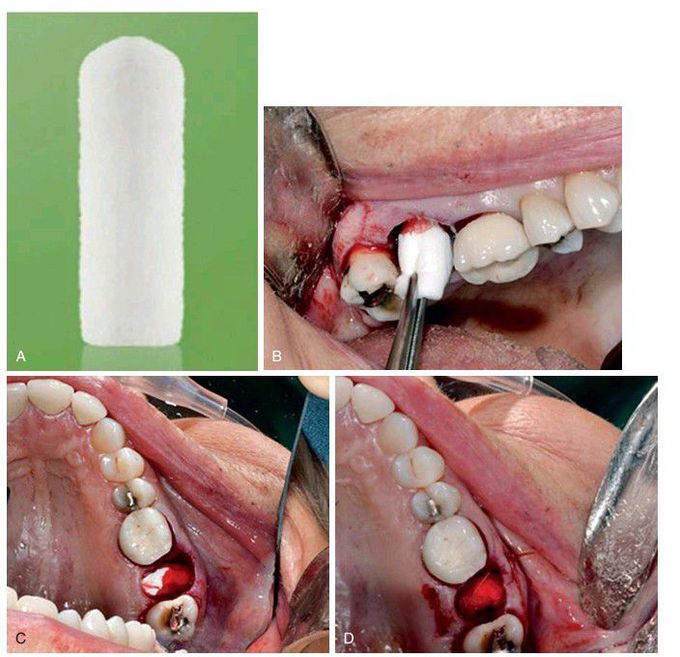 Postoperative bleeding