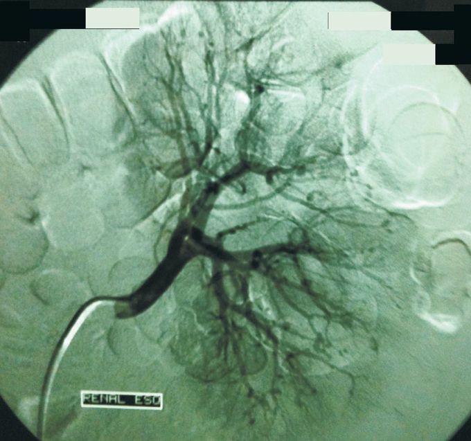 Bilateral Foot Drop in Polyarteritis Nodosa
