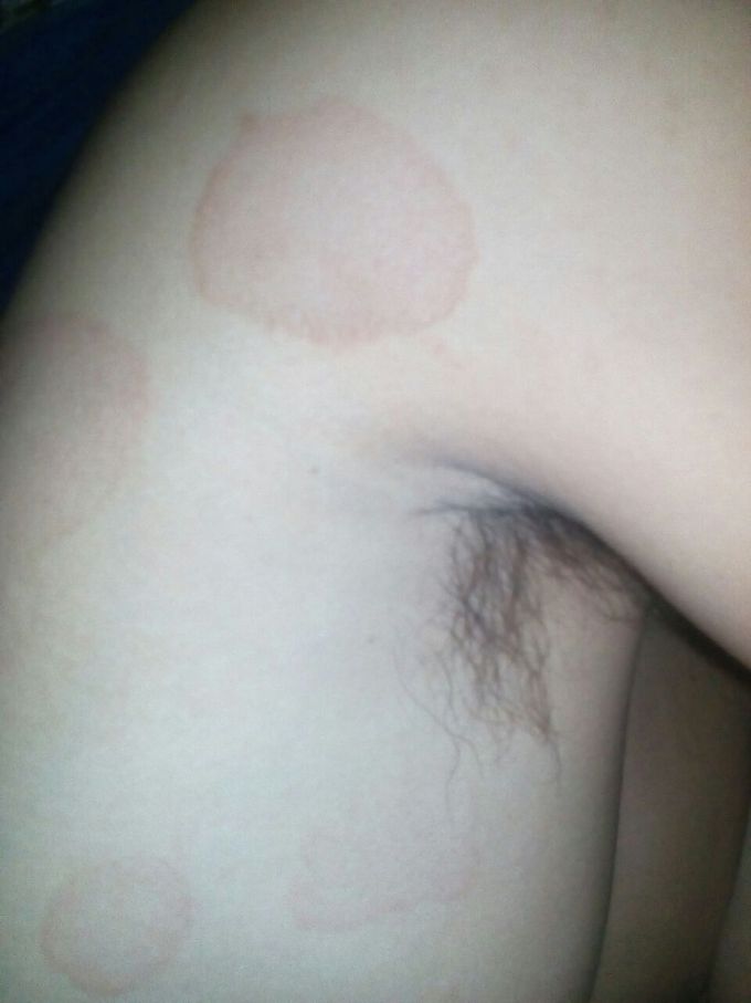 What's diagnosis this patient and how's treatment