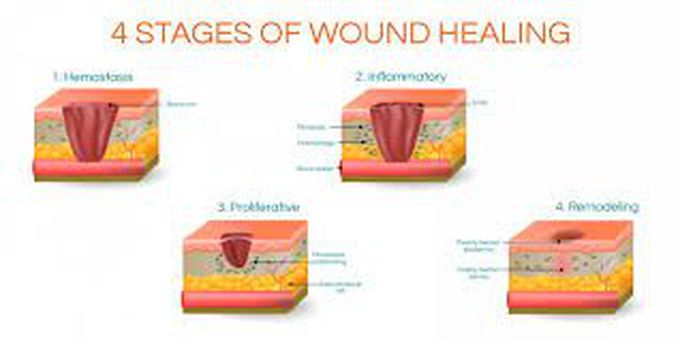 Stages of wound healing - MEDizzy