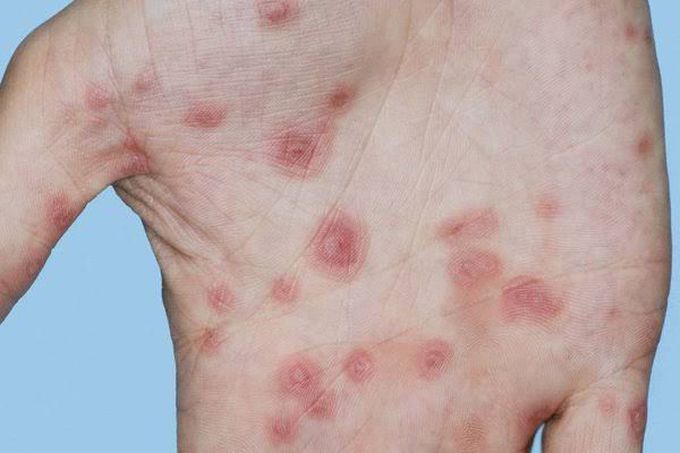 Erythema Multiforme