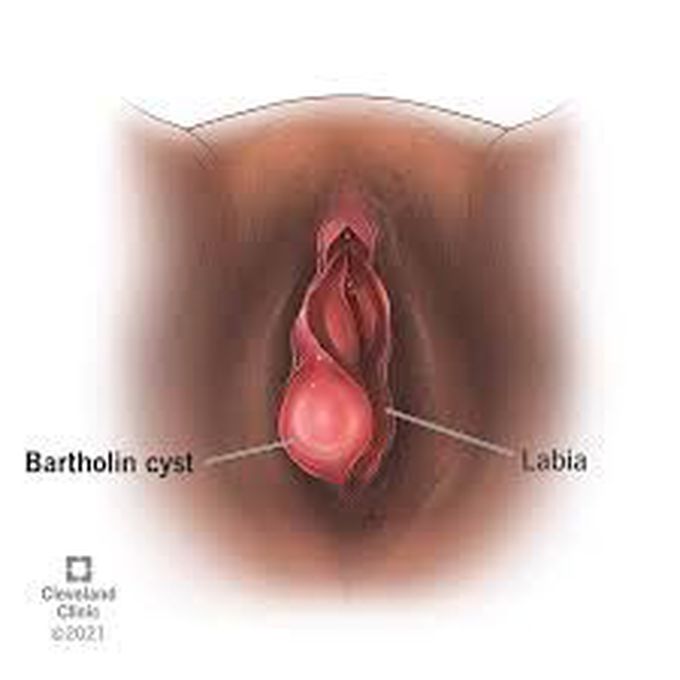What is bartholin cyst