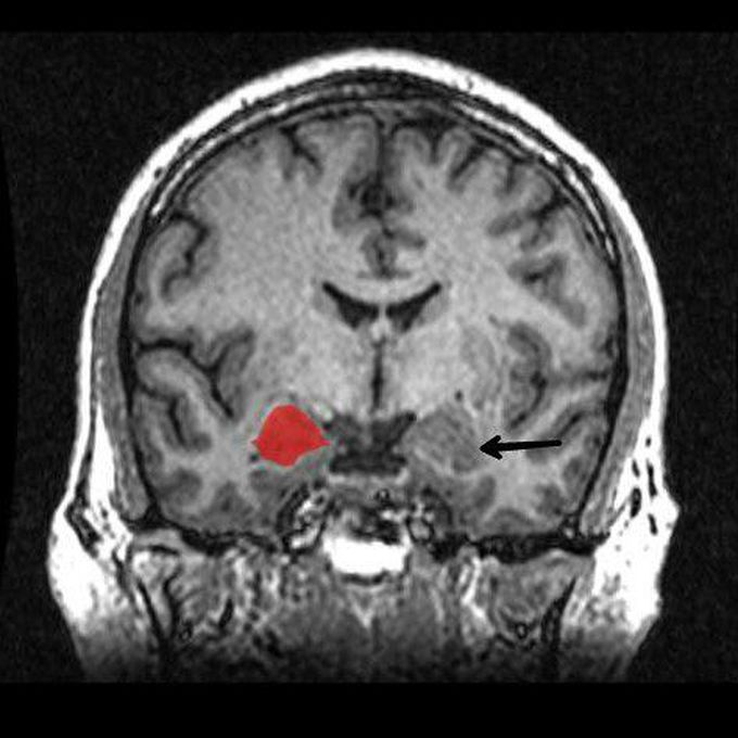 Kluver Bucy syndrome