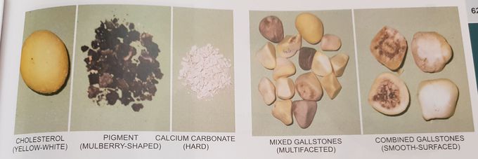 Gallstone