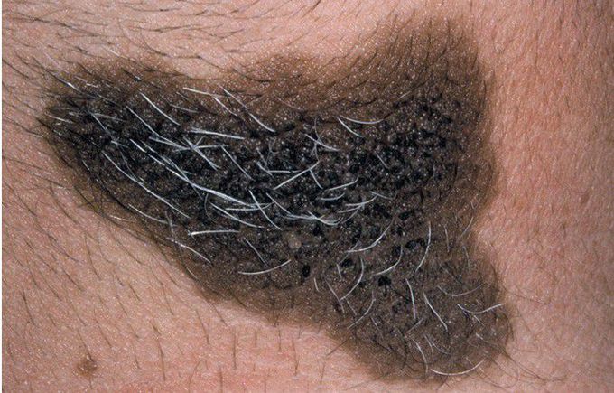 Congenital Melanocytic Nevus