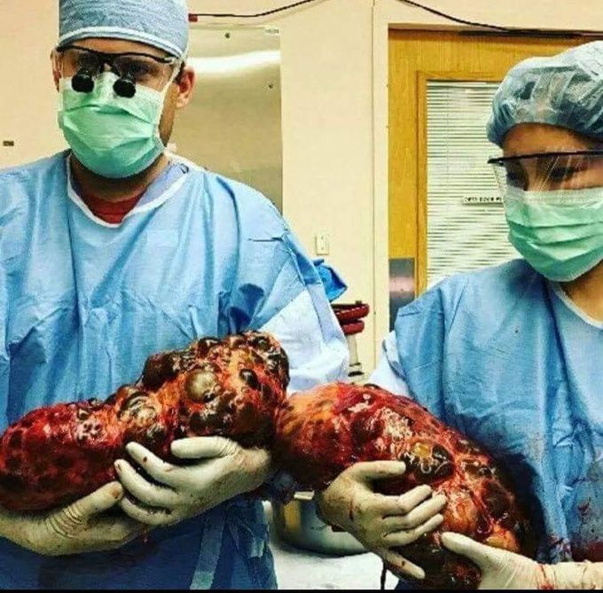 End-stage Polycystic Kidney Disease!