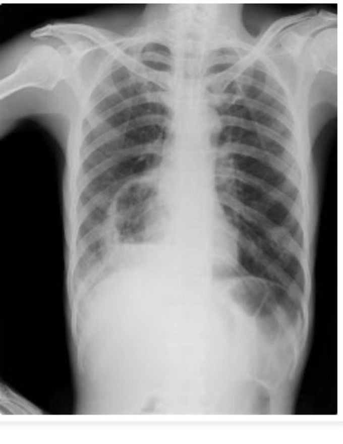 Lung abscess