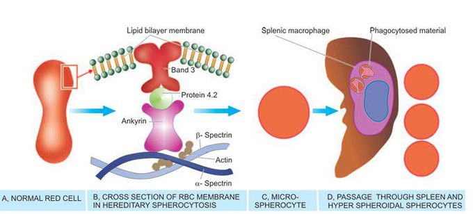 Diagrammatic representation of pathogenesis of hereditary spherocytosis