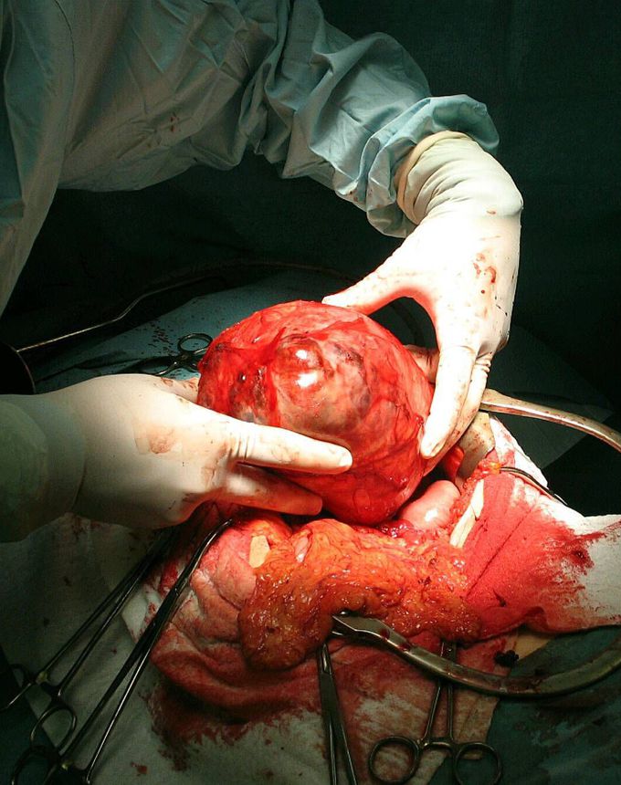 Enormous ovarian fibroma