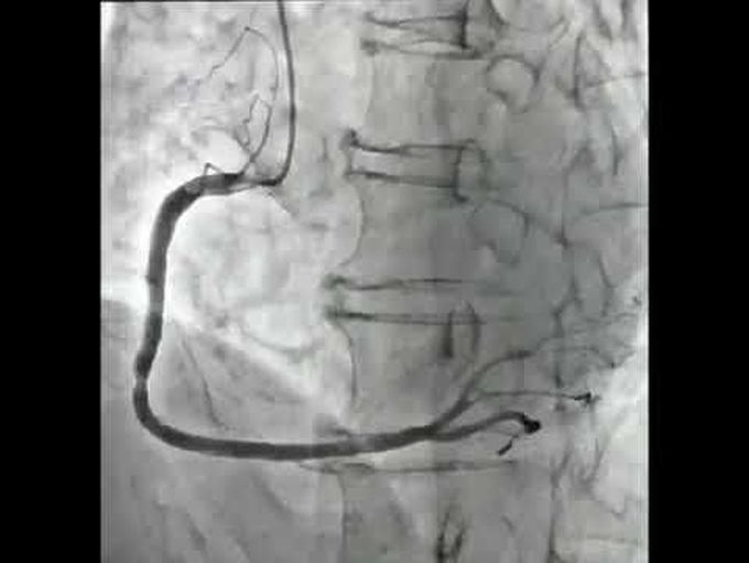 Coronary Angiography with Acetylcholine Injection  *  Coronary-Artery Vasospasm