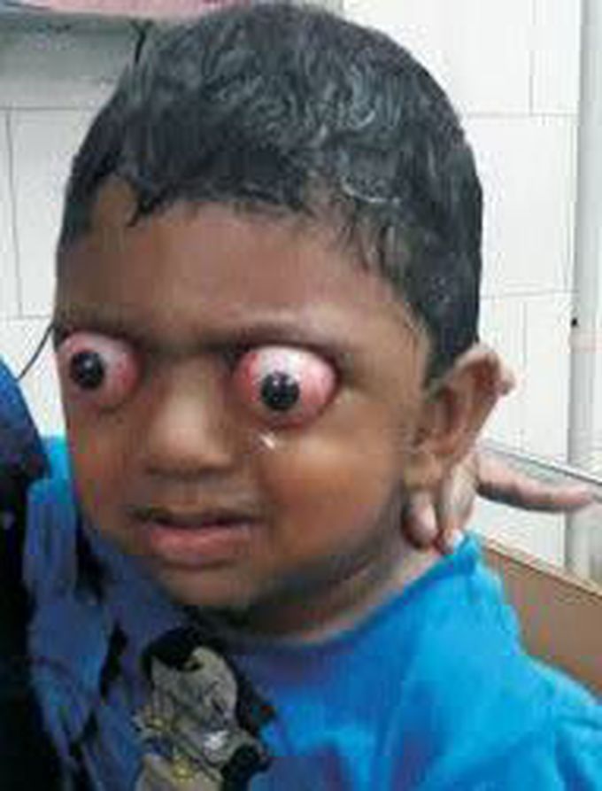 Subluxation of eyes in a child with Crouzon Syndrome.