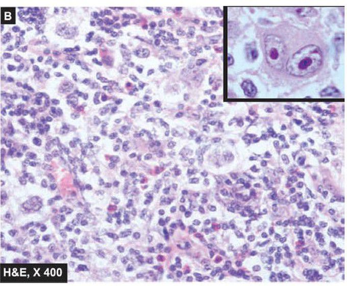 Mixed cellularity type