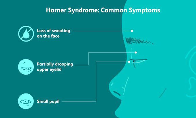 These are the symptoms of Horner's syndrome