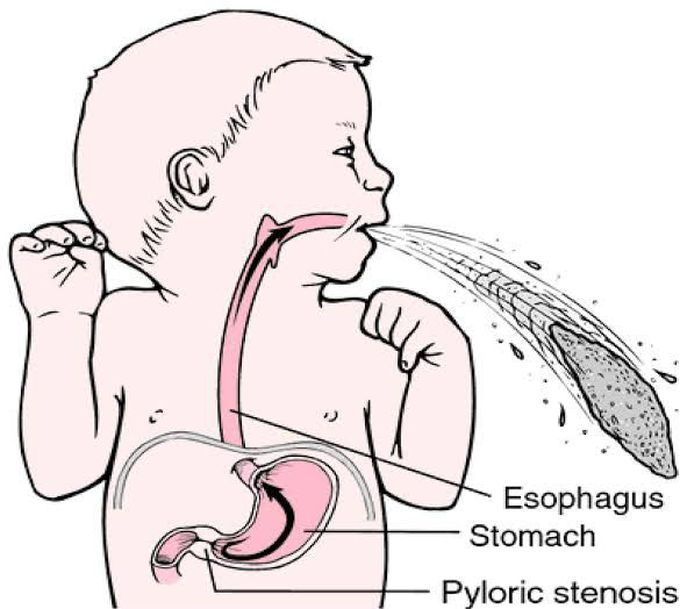 Pyloric stenosis symptoms