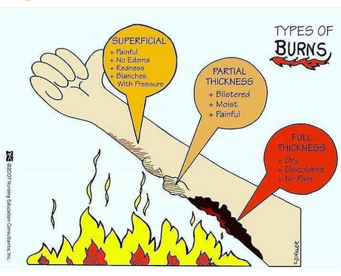 Types of burns