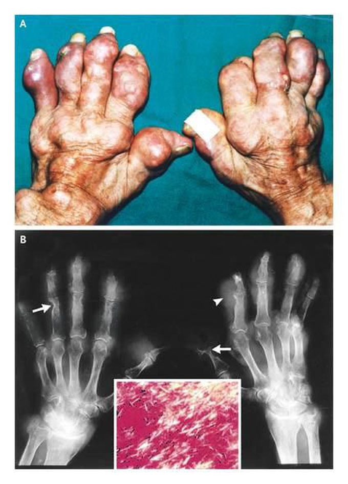 Deforming Gout