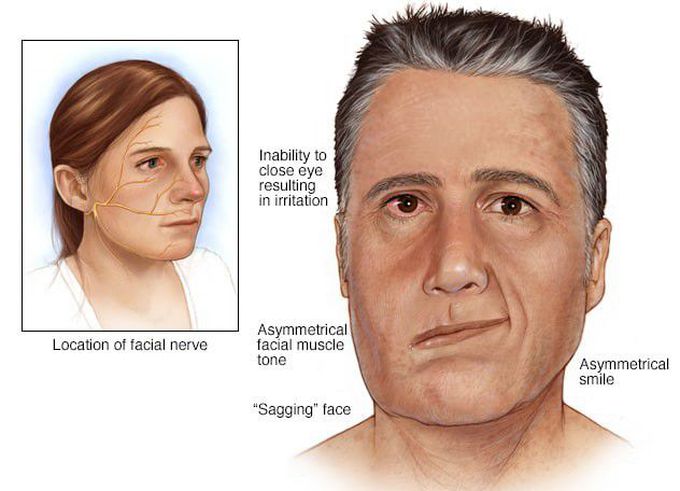 Bell's Palsy - MEDizzy