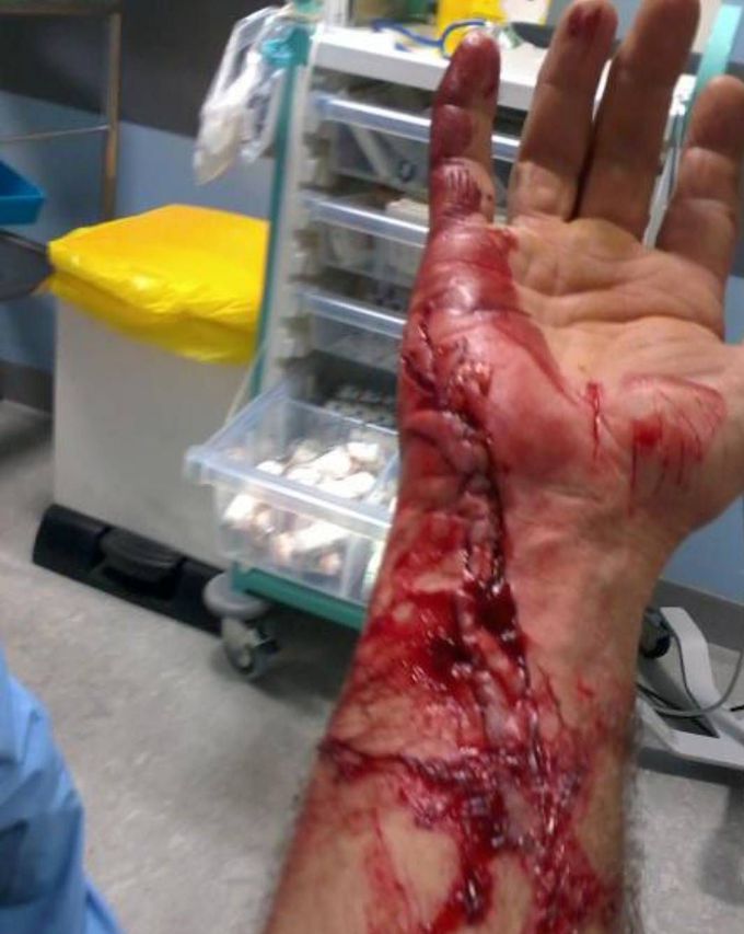 Unfortunate chainsaw accident