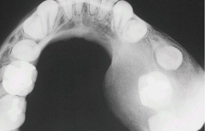 Fibrous Dysplasia.