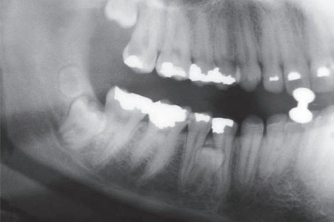 Supernumerary premolar