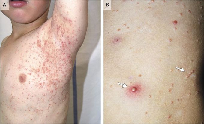 Molluscum Contagiosum in a Patient with Atopic Dermatitis