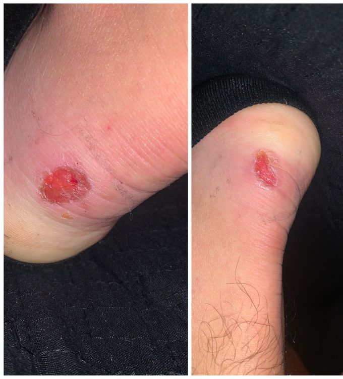 I went out with new boots in new year’s eve, how can i cure this the to heal well?