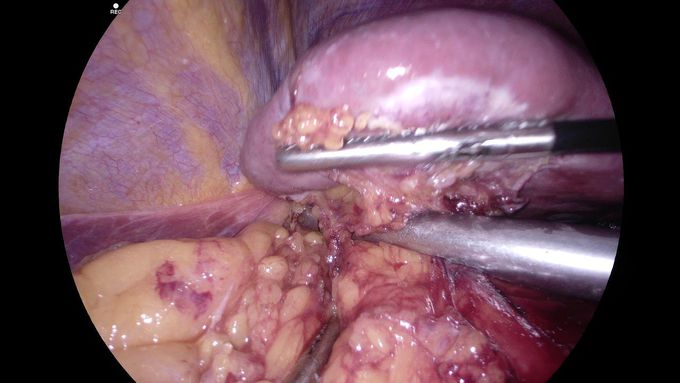 Laparoscopic Splenectomy for ITP