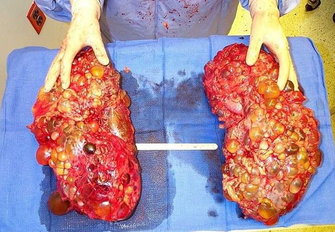 Policystic kidney disease