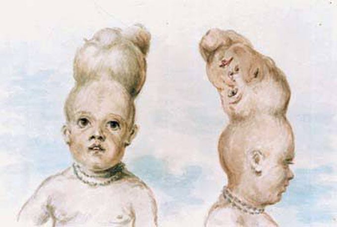 Craniopagus Parasiticus Double Head MEDizzy