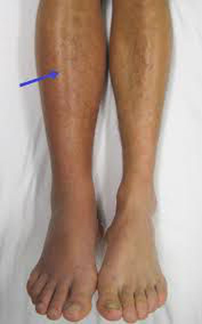 What causes deep vein thrombosis?