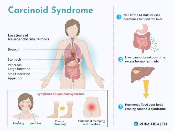 Carcinoid Syndrome