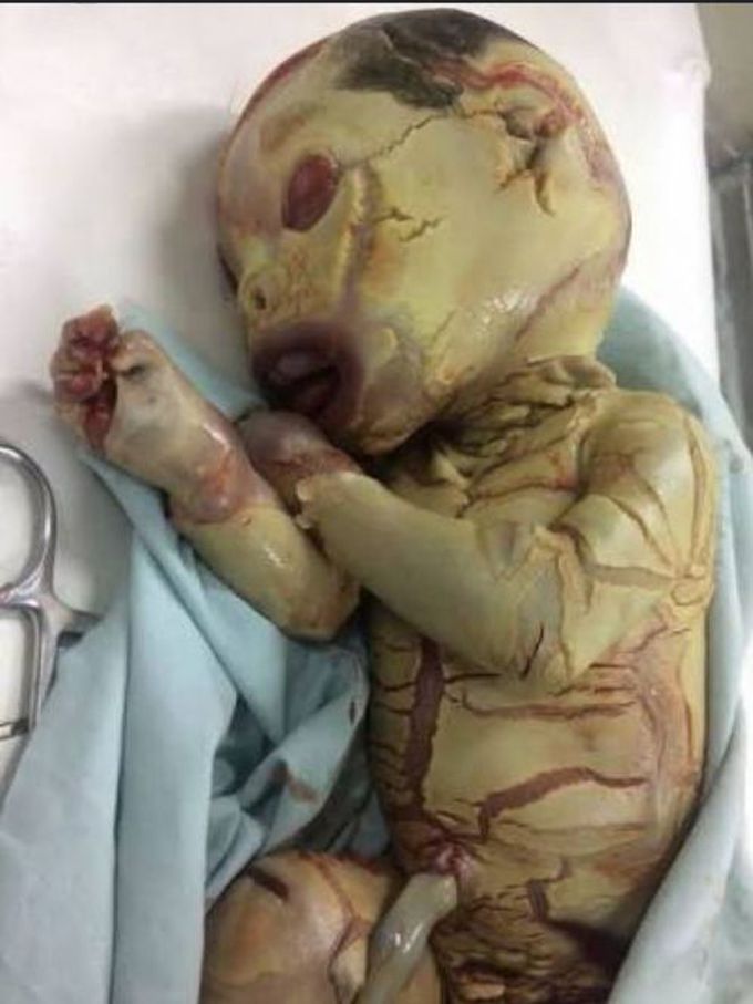 HARLEQUIN ICHTHYOSIS