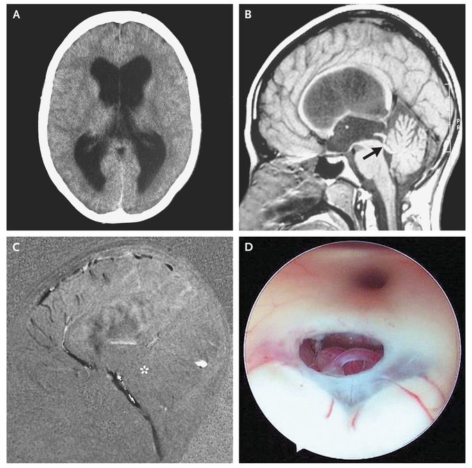 Idiopathic Aqueductal Stenosis