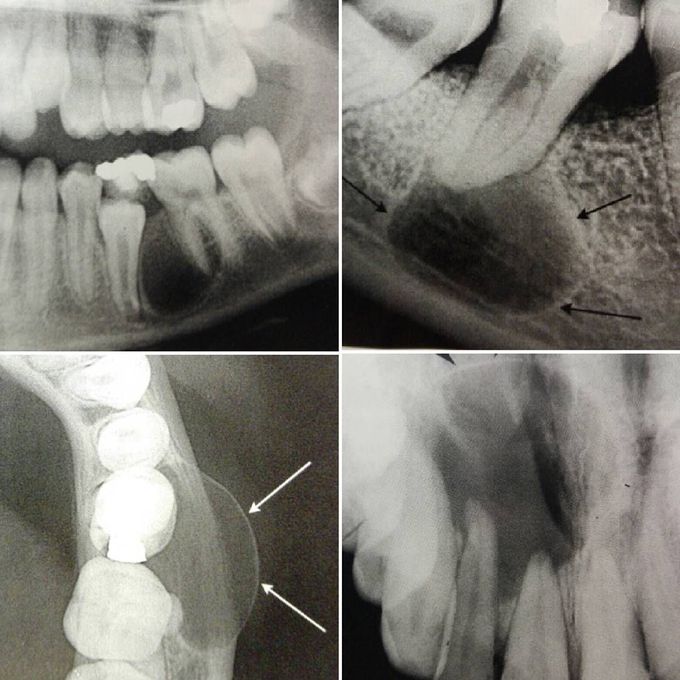 Radicular Cyst