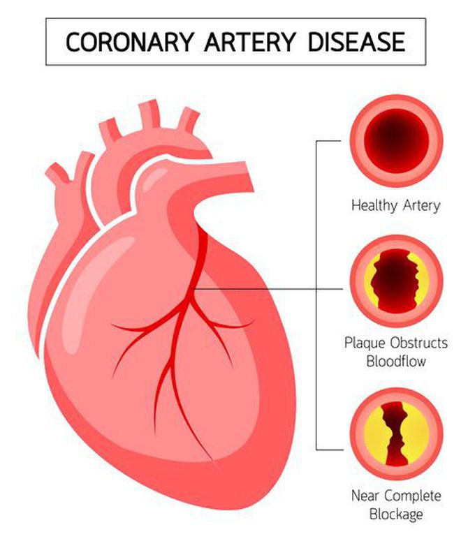 What Is Coronary Artery Disease?

Coronary artery disease, also called CAD, coronary or atherosclerotic heart disease, is a serious condition caused by a buildup of plaque in your coronary arteries, the blood vessels that bring oxygen-rich blood to your heart. It affects millions of Americans.

Your arteries are smooth and elastic. But when plaque builds up on their inner walls, it can make them stiff and narrow. This slows blood flow to your heart muscle, so it doesn’t get the oxygen it needs.

The plaque could also break off, leading to a heart attack or sudden cardiac death.

Coronary Artery Disease Symptoms

The most common symptom is angina, or chest pain.

People describe angina as:

Aching

Burning

Fullness

Heaviness

Numbness

Pressure

Squeezing

Weakness or dizziness