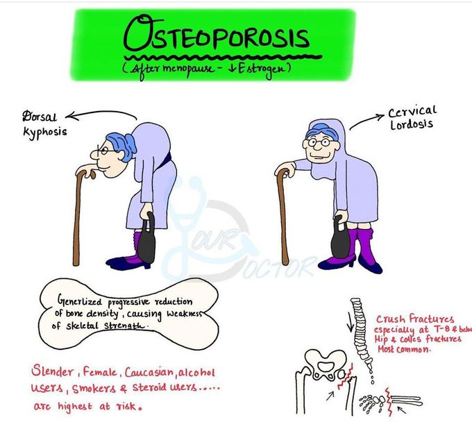 Osteoporosis