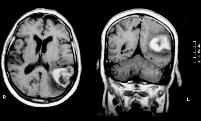 Gerstmann Syndrome