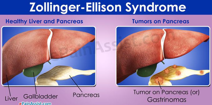 What Are the Symptoms of Zollinger-Ellison Syndrome?

People who have Zollinger-Ellison syndrome don't always have symptoms. When symptoms do occur, they include:

 

Abdominal pain
Burning pain in the abdomen
Nausea
Diarrhea
Weight loss
Vomiting
Bleeding from the stomach
Weakness
Fatigue