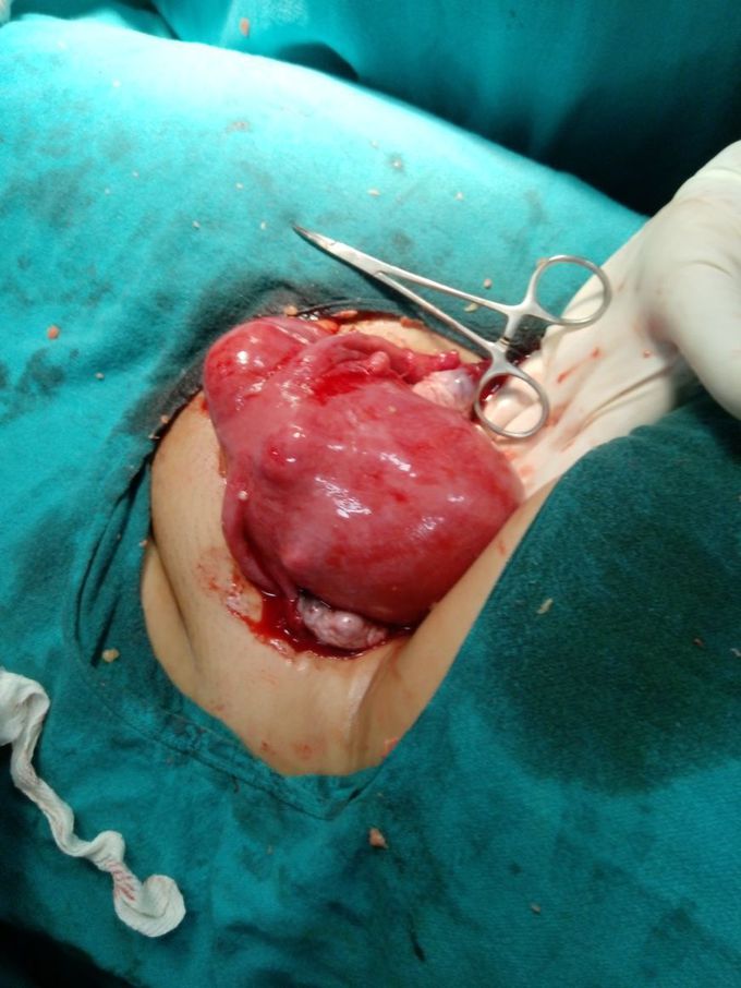 Mass in uterus what's the D/D