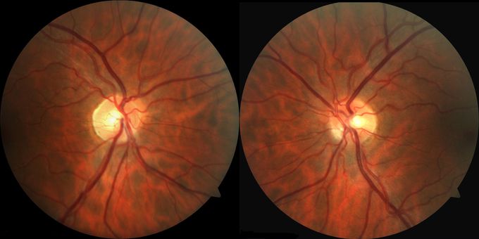 Optic Neuritis in Multiple Sclerosis